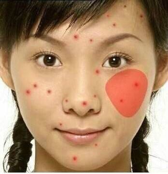 长痘真的影响颜值教你祛痘小妙招,祛痘小知识如何正确避免长痘