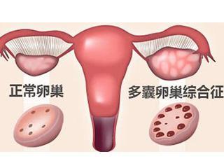多囊卵巢综合症有什么症状表现,多囊卵巢综合症的症状和危害