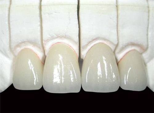 烤瓷牙齿步骤,烤瓷牙齿的做法大全