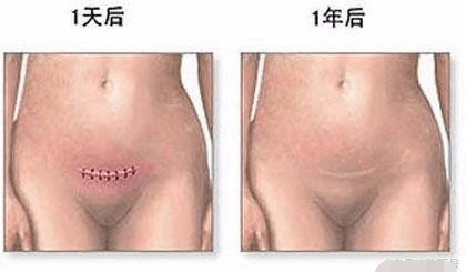 剖腹产手术全过程图解，需要切开7层才能将宝宝取出