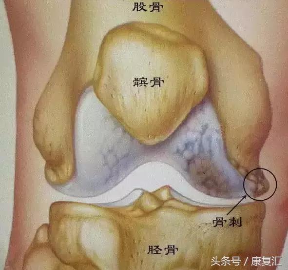 骨刺其实不是病千万不要过度治疗,骨刺真的就如你想象一般可怕吗