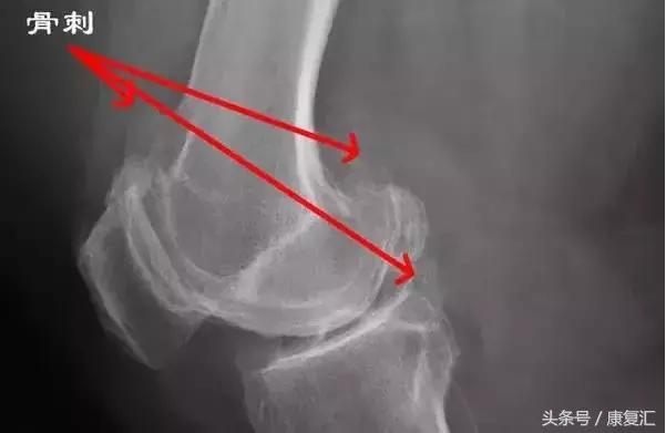 骨刺其实不是病千万不要过度治疗,骨刺真的就如你想象一般可怕吗