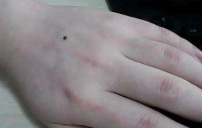 女人右手手背突然长痣代表什么,女人左手手背上有颗痣