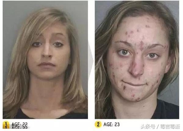 吸毒前后的变化对比,吸毒真的会毁容吗