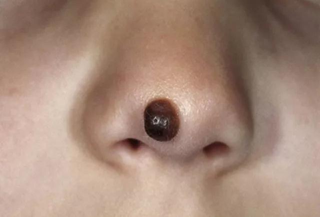 5招教你辨别痣和瘤,怎样区分痣和瘤