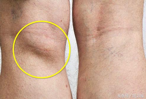 高中生膝盖疼痛的原因和解决方法,爬楼梯膝盖疼痛的原因和解决方法