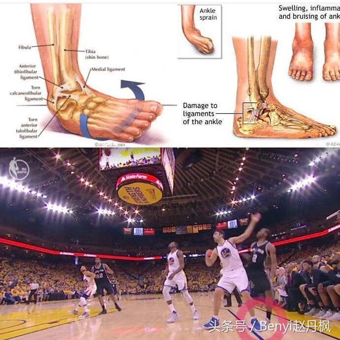 脚踝伤病的六个问题,脚踝受伤康复训练篮球