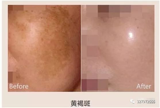 色斑形成的原因及淡化方法，摆脱色斑肌肤困扰