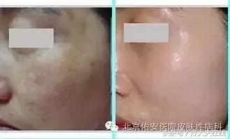 褐斑的最佳治疗方法,褐青色斑最好的治疗方法