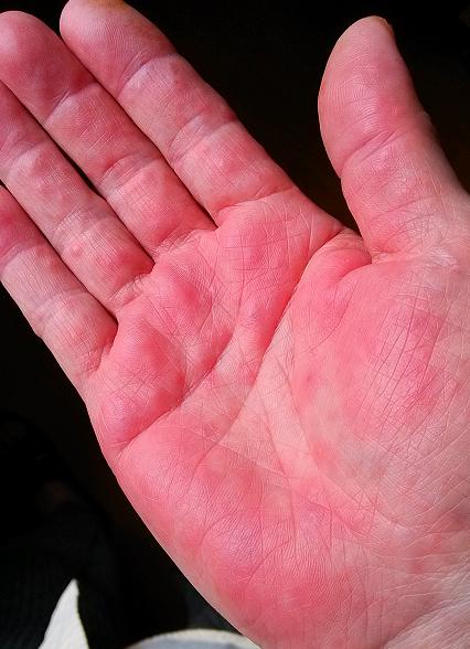 中美联手成功案例,双安联合治疗肝癌