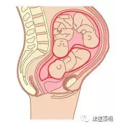 三胞胎在一个子宫吗,三胎双胞胎单角子宫