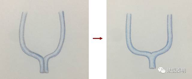 三胞胎在一个子宫吗,三胎双胞胎单角子宫