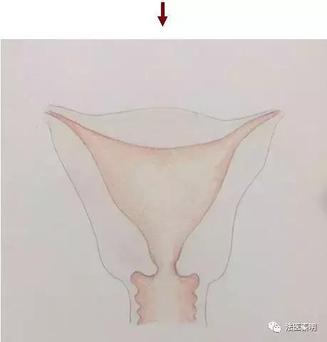 三胞胎在一个子宫吗,三胎双胞胎单角子宫
