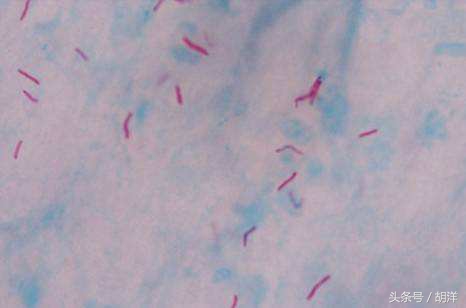 结核菌如何可以确诊,得了结核以哪个检查为准