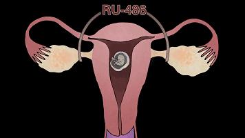 流产和宫外孕哪个可怕,流产跟怀孕有什么关系