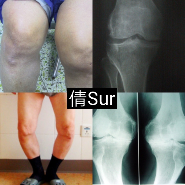 膝关节损伤肿胀的消除方法,关节肿胀完全消除