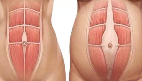 产后修复健身能恢复好身材吗,产后修复塑形瘦身