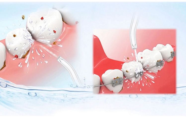 号称能去除菌斑牙的冲牙器,牙菌斑有了用牙刷还是冲牙器