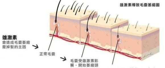 下巴反复长白头粉刺是激素痘吗,下巴有很多小白头粉刺怎么回事