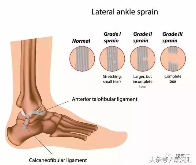 踝关节扭伤正确处理方法是,董氏奇穴治疗踝关节扭伤