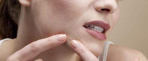 下巴反复长白头粉刺是激素痘吗,下巴有很多小白头粉刺怎么回事