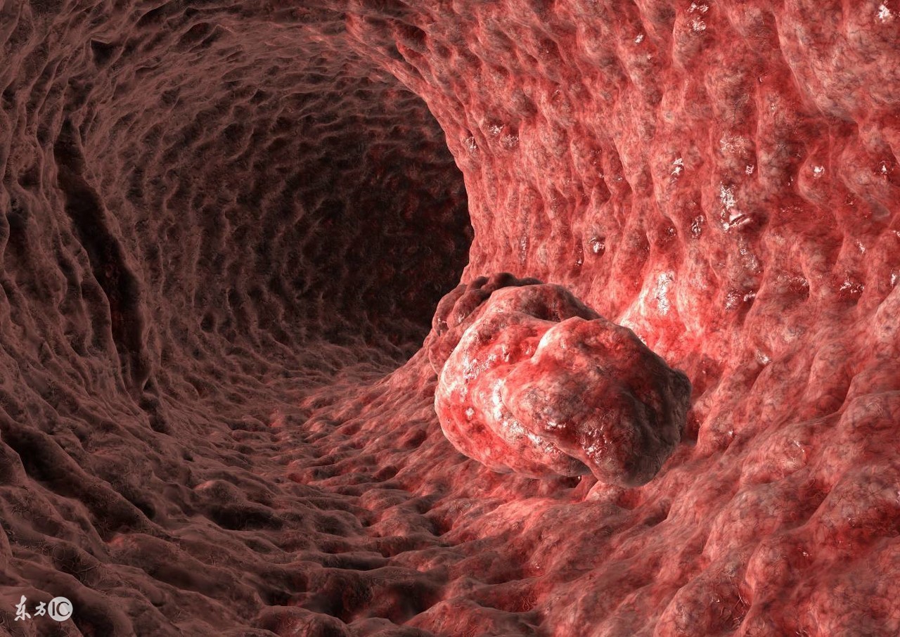 直肠癌的早期症状和痔疮的区别,不是直肠癌容易被误诊为直肠癌吗