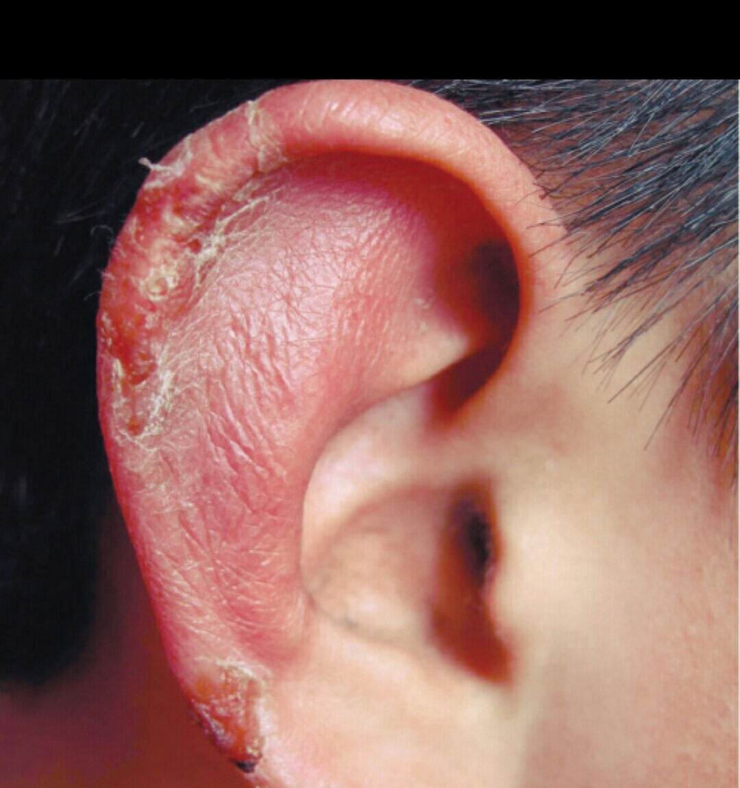 冻伤疮最佳治疗方案,冻伤疮什么意思