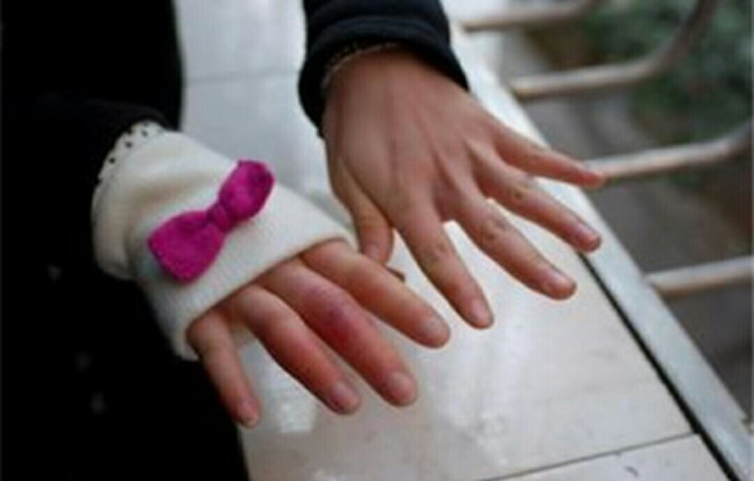 冻伤疮最佳治疗方案,冻伤疮什么意思