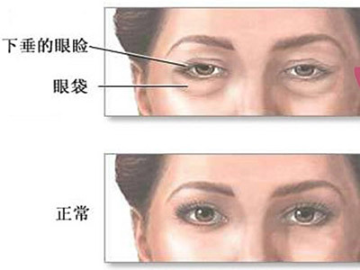 有没有去眼袋的亲测有效的方法,10个简单有效的去眼袋方法