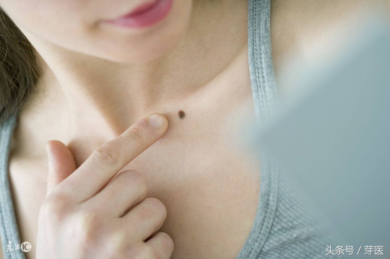 突然长大的痣是不是会癌变,痣怎么预防变瘤