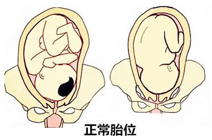 产妇胎位不正医生纠正难产完整版,孕妇胎位不正什么原因导致的