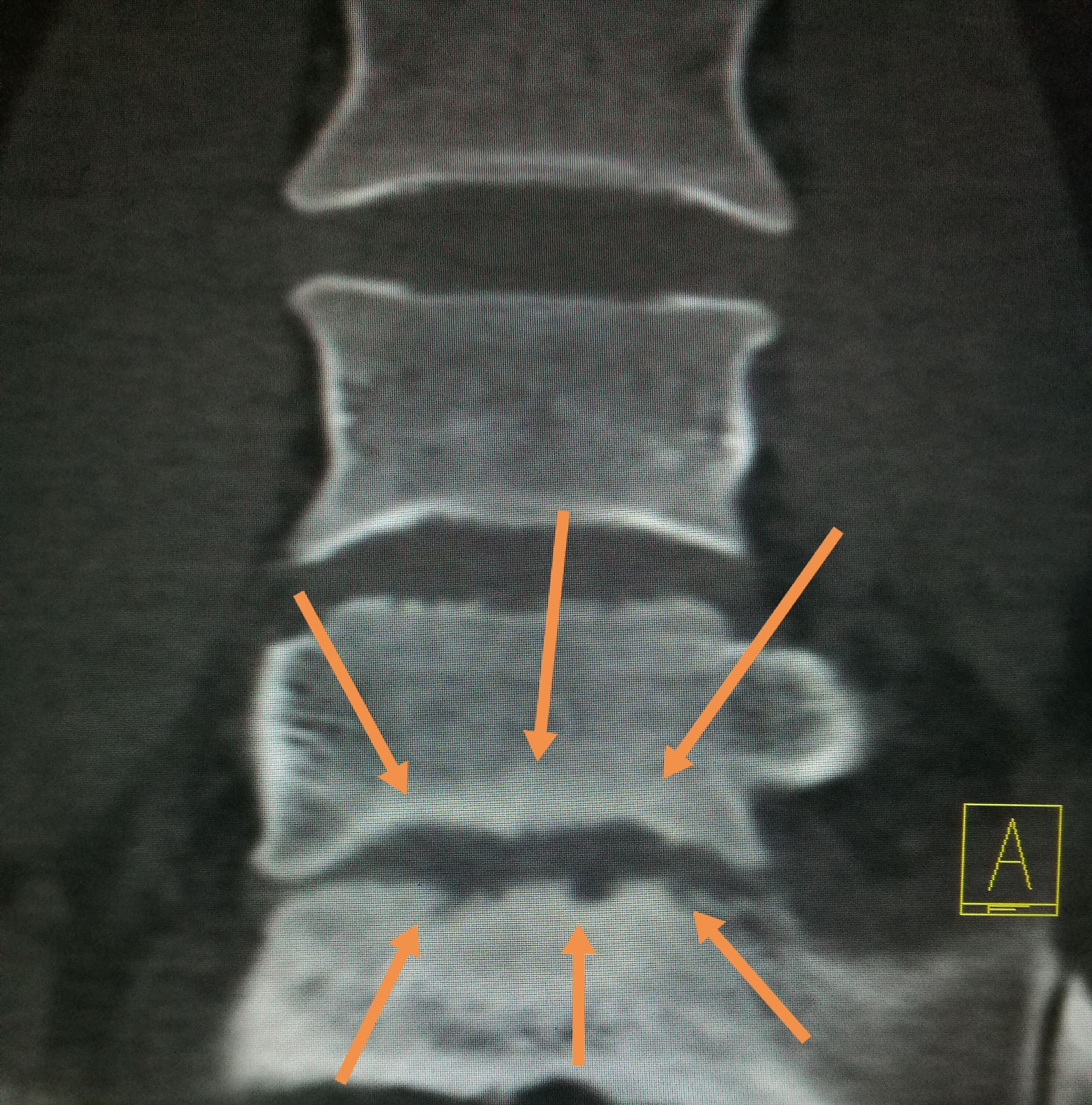 常吃牛羊肉，出现腰背痛，小心☞布鲁氏病
