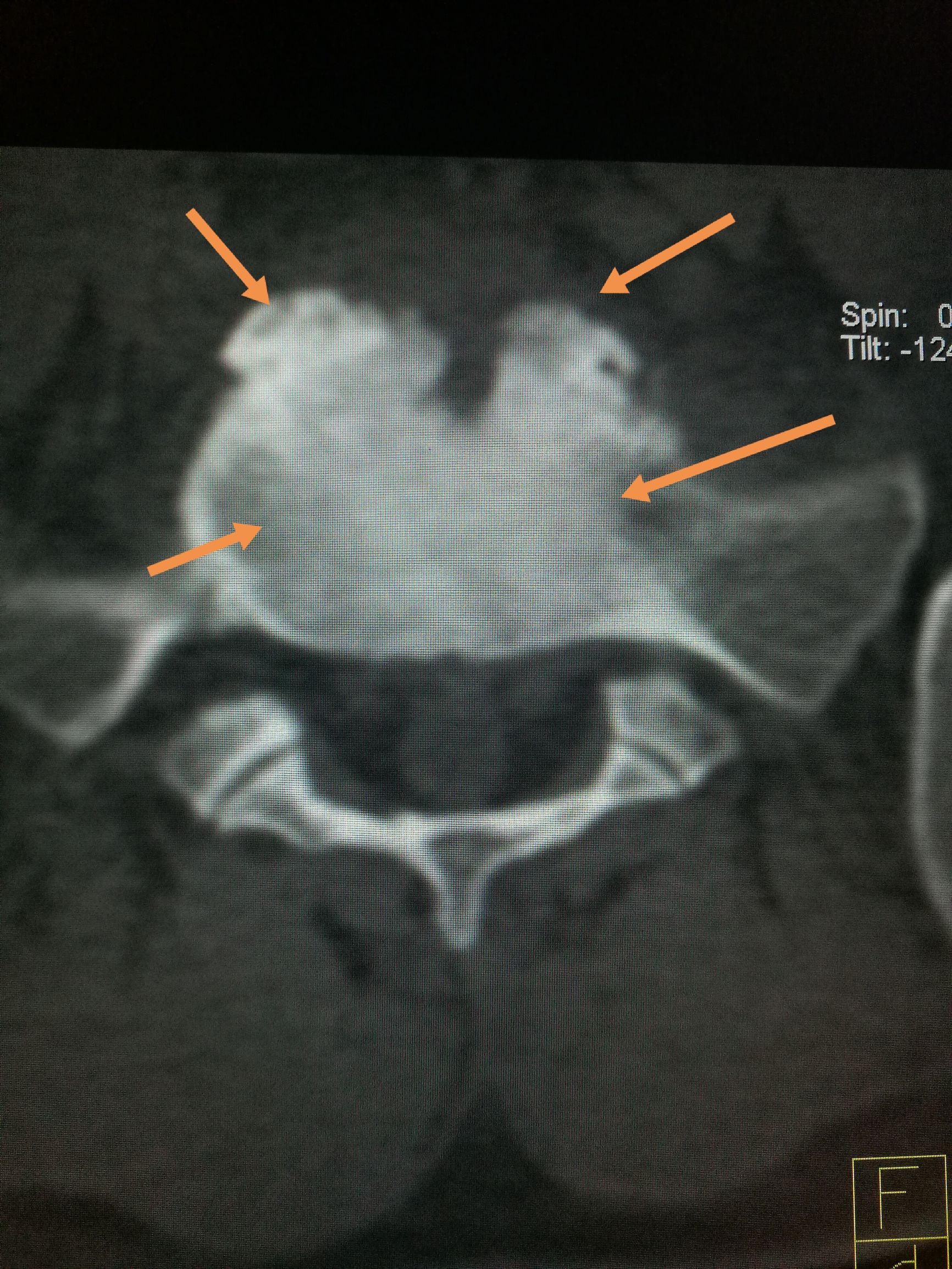 常吃牛羊肉，出现腰背痛，小心☞布鲁氏病