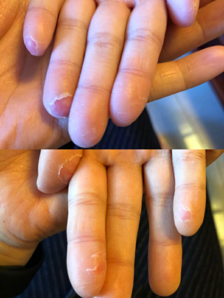 猩红热夏季,猩红热要保暖吗