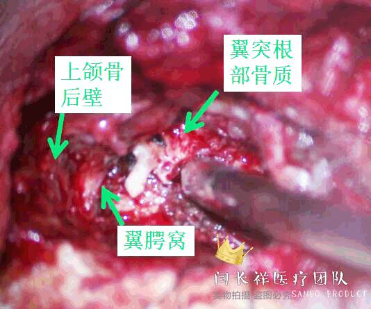 烦人的耳鸣,烦人耳鸣