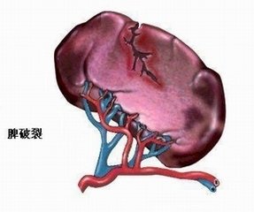 如果把脾脏切了以后会注意什么,脾脏大一定要切吗