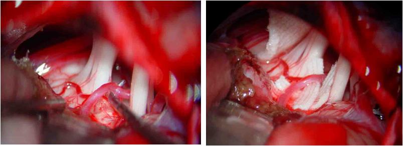三叉神经痛和继发性的三叉神经痛,三叉神经贴治疗三叉神经痛的原理