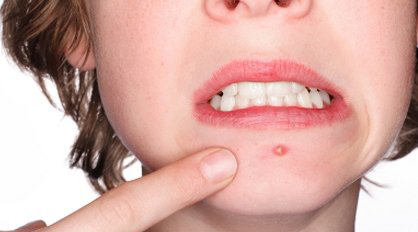 反复长痘的真凶你找到了吗,8个容易长痘的生活习惯你知道吗