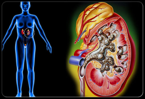 盆腔疼痛怎么引起的,盆腔疼痛是什么原因引起的
