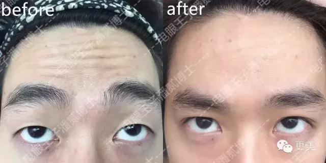 抬头纹手术会不会影响眼睛,抬头纹手术后有后遗症吗