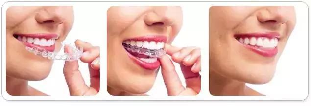 美丽刻隐形矫正怎么样,隐形矫正牙齿视频教程