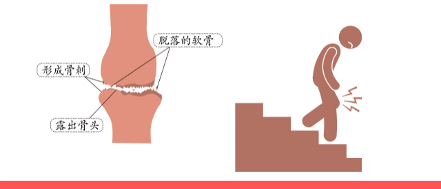 老年骨关节炎最佳治疗方法,老年骨关节炎最好的治疗方法