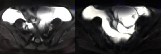 女性下腹疼痛是什么病,女性下腹疼痛的预兆