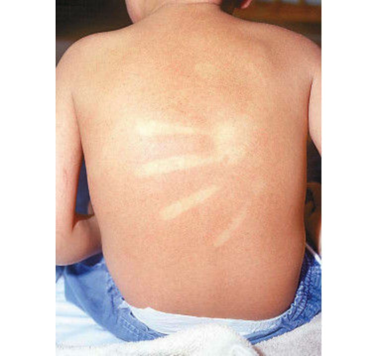 猩红热夏季,猩红热要保暖吗