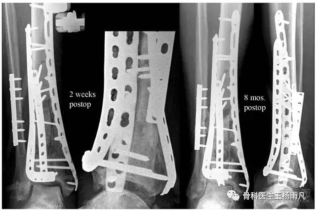 取钢板一般需要几年后取,取钢板多长时间取最合适
