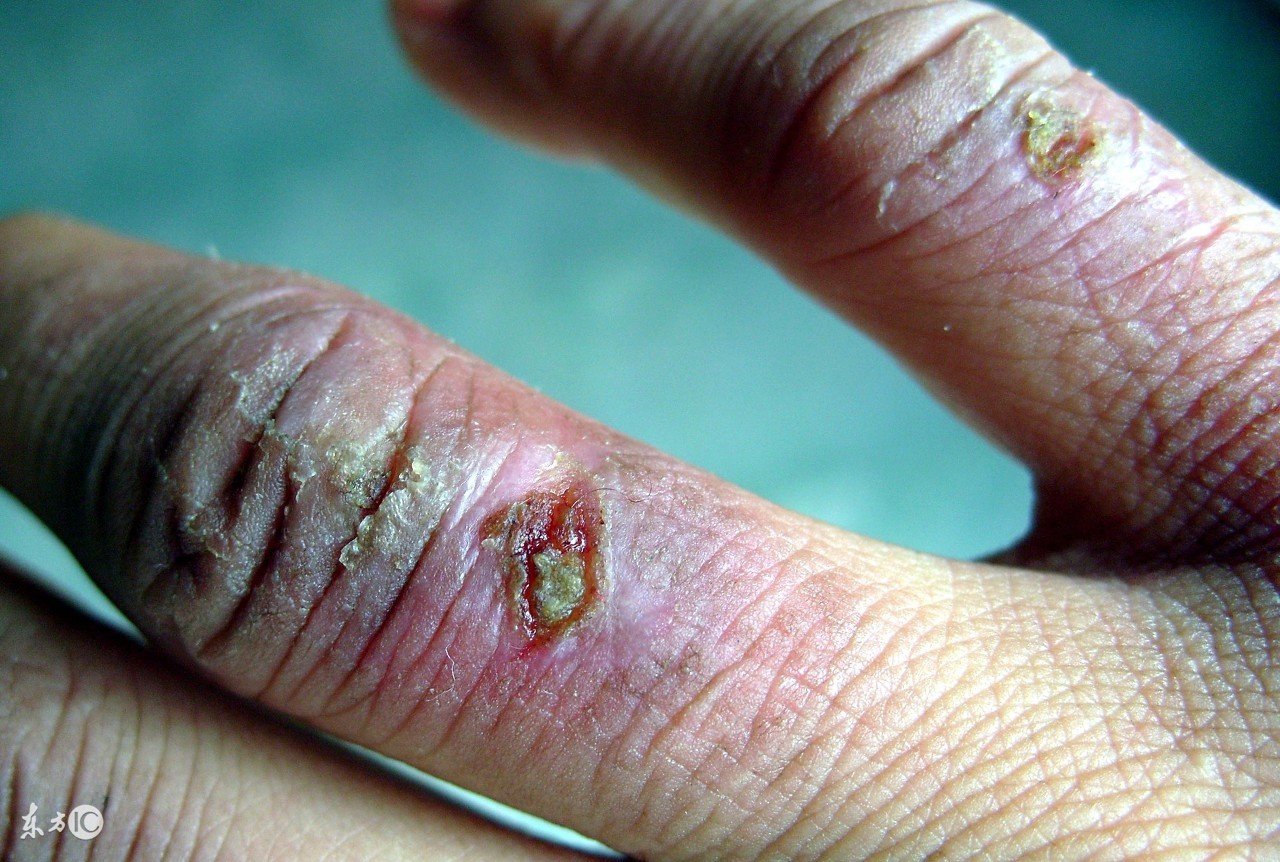 妙！防治各类冻疮的16种中成药