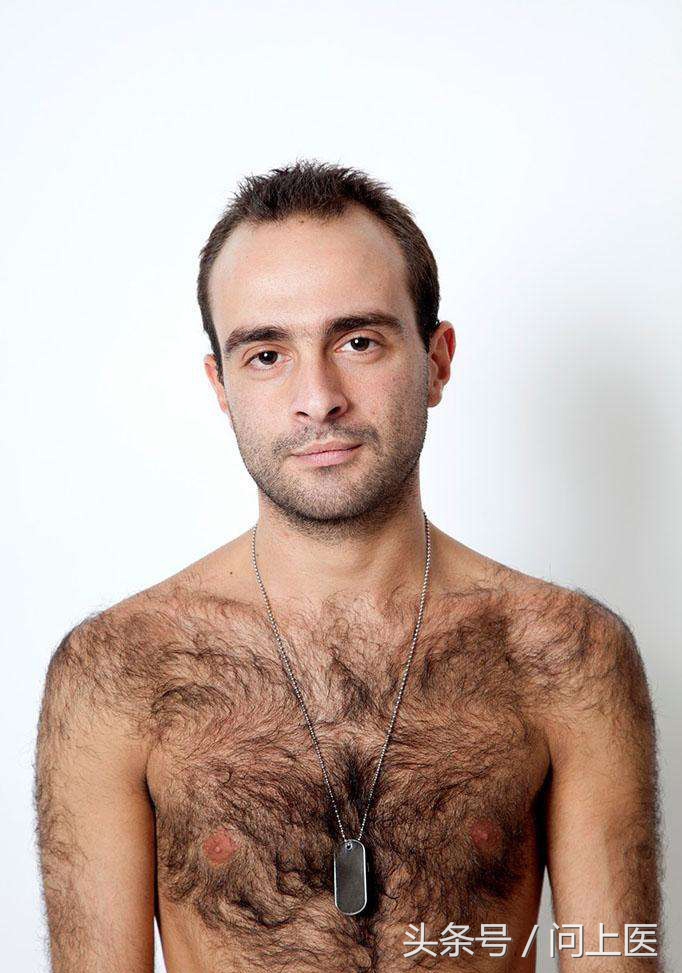 全身有体毛就是多毛症吗,病态性多毛症状