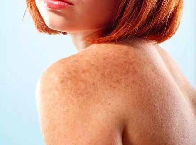 果酸换肤美白效果,果酸换肤和m22光子嫩肤哪个先做