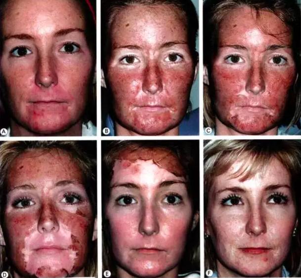 果酸换肤美白效果,果酸换肤和m22光子嫩肤哪个先做