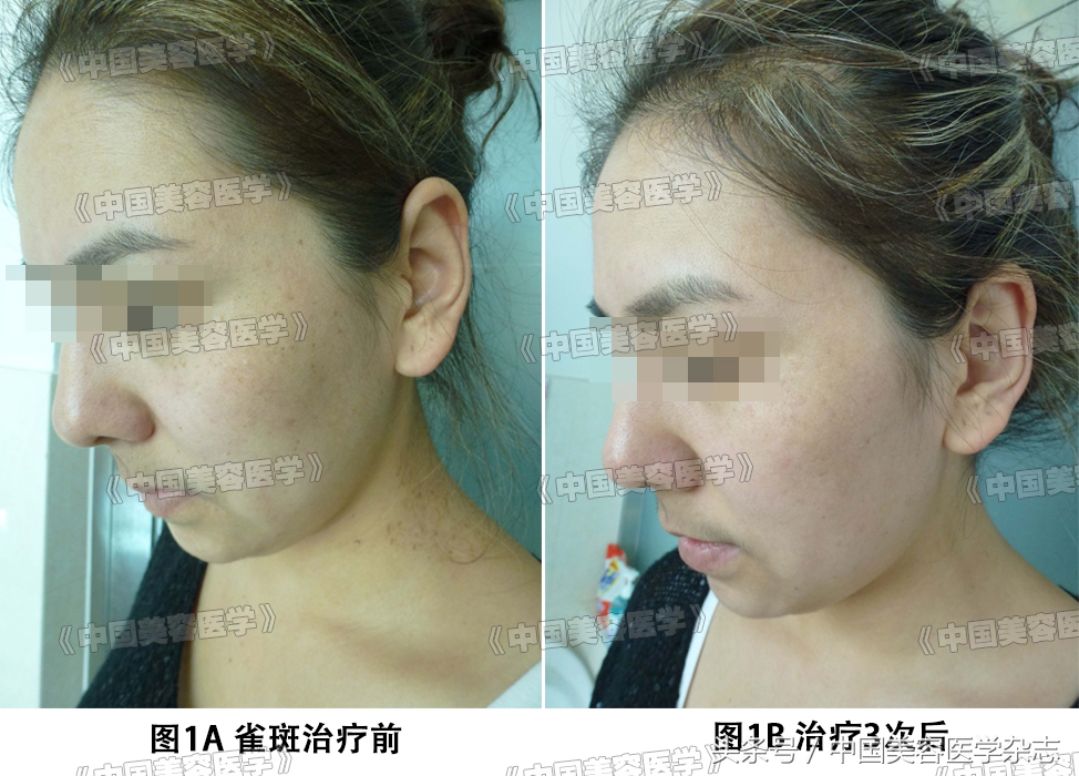 调Q激光能治疗鲜红斑痣吗,染料激光治疗色素增加性皮肤病